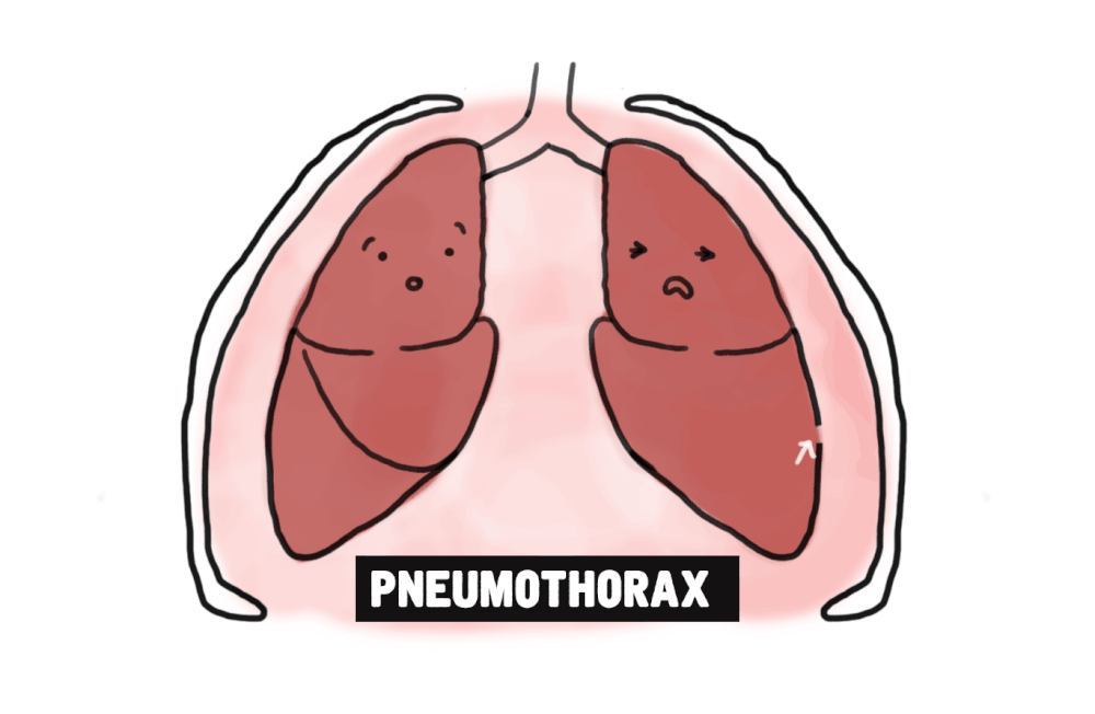 adventitious breath sounds of pneumonia