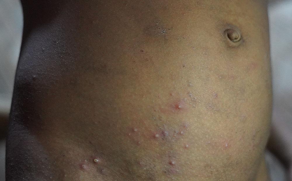 Scabies Rash on Black Skin: Symptoms and Treatment