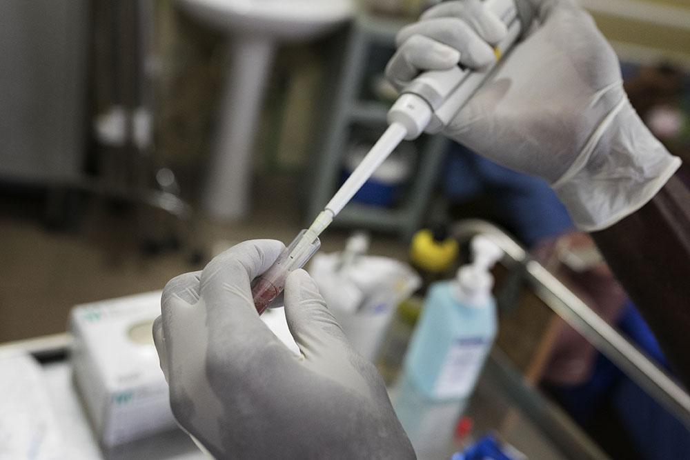 An MSF nurse performs a Cryptococcal Antigen (CrAg) screening test to test for Cryptococcal Meningitis in an AIDS patient